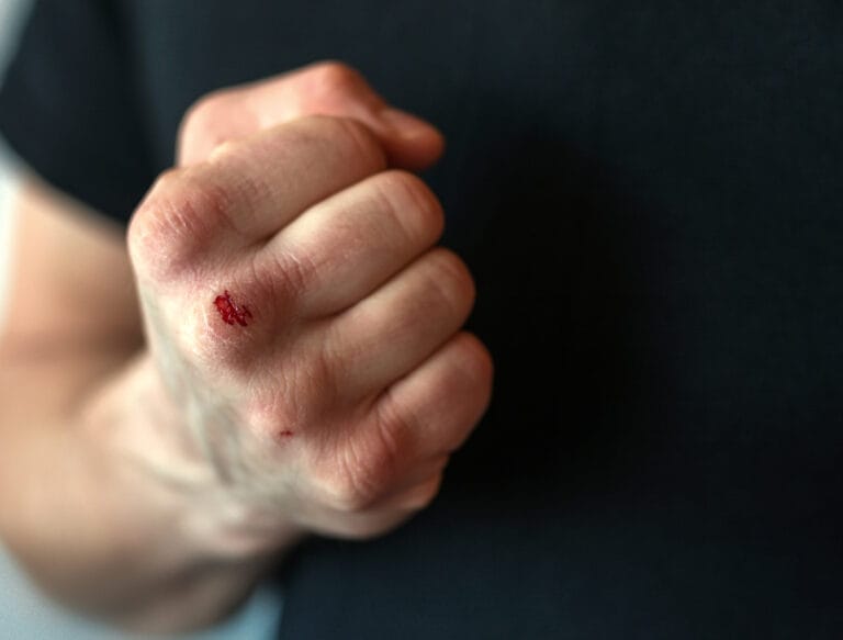 A bloodied fist to illustrate corporal injury to a spouse or cohabitant charges in California